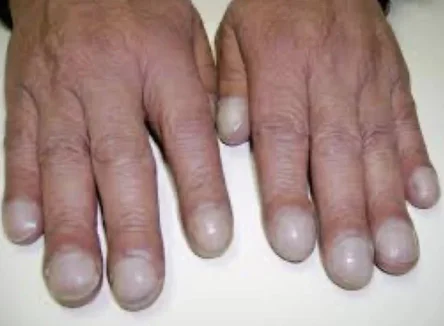 Trommelschlegelfinger Zwei Hände nebeneinander mit deutlich verdickten, kolbenförmig aufgetriebenen Fingerkuppen – ein typisches Erscheinungsbild von Trommelschlägelfingern als mögliches Symptom bei Lungenfibrose.